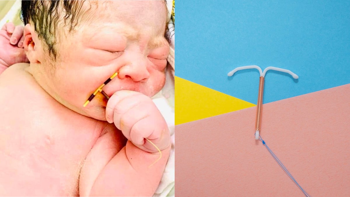 Poti Pastra Sarcina Cu Sterilet Un bébé né avec le stérilet de sa mère dans la main | Le Bonbon